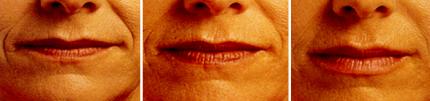 Commissures labiales - Plis d'amertume : avant / après