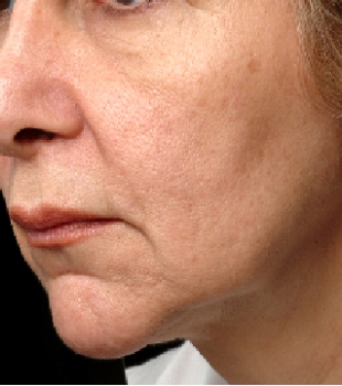 Continued Improvement Over Time - 2 Months Post Thermage