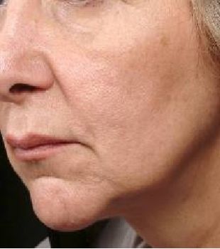 Continued Improvement Over Time - 4 Months Post Thermage
