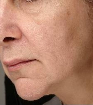 Continued Improvement Over Time - 6 Months Post Thermage