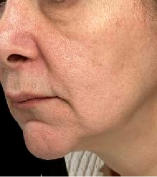 Continued Improvement Over Time - Before Thermage