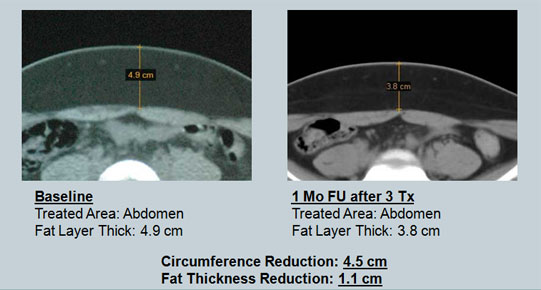 CT Scans Three Treatment Results