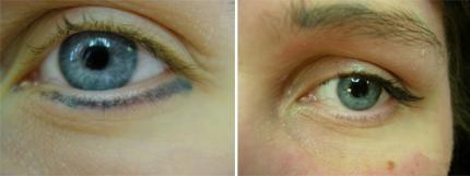 Détatouage d'un eye liner au laser Q Switched 1064 nm avant et après 7 séances