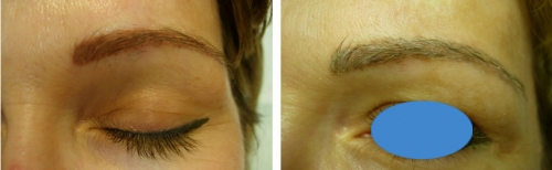 Détatouage des sourcils dermopigmentés au laser