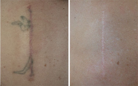 Détatouage laser à Montpellier par le Dr Bousquet