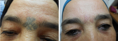 Détatouage rituel au laser