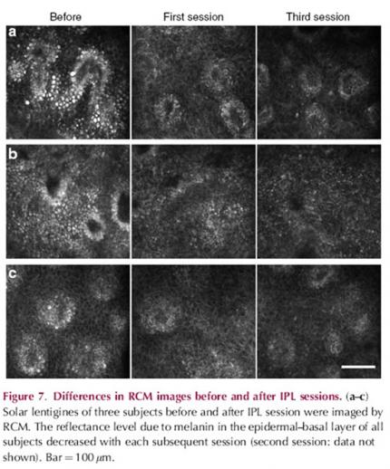 Differences in RCM images before and after IPL session