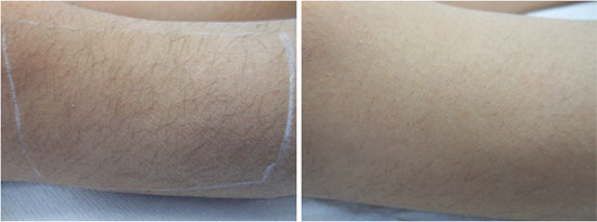 Epilation laser par le Dr Bousquet à Montpellier