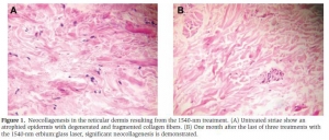 Fractional non-ablative 1540 nm Laser Treatment of Striae Distensae