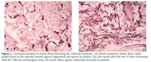 Fractional non-ablative 1540 nm Laser Treatment of Striae Distensae