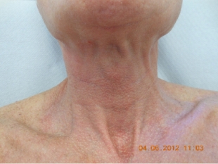 Fraxel 1550 nm