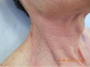 Fraxel 1550 nm