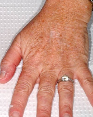 Fraxel re:store® Laser