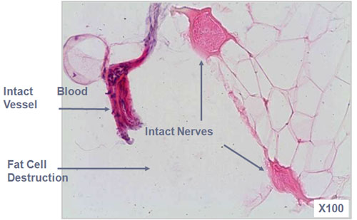 In-vivo Porcine Model: Acute Micro Effects