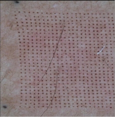 Lasers Fractionnés