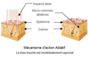 Lasers Fractionnés