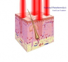 Lasers Fractionnés