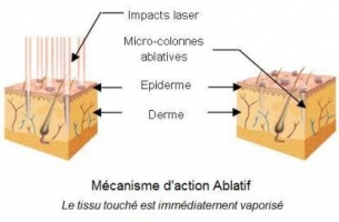 Lasers Fractionnés