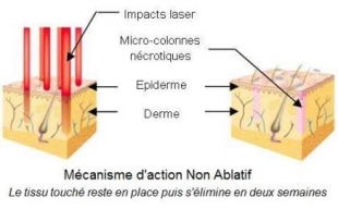 Lasers Fractionnés