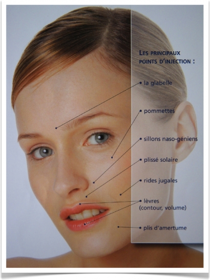 Les proncipaux points d'injection