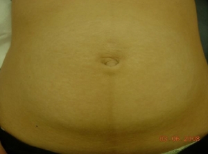 Nd;Yag LP - ND:Yag 1064 nm2 months post 4 Tx