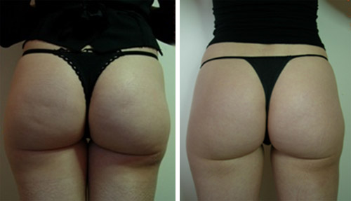 Photo avant / après remodelage des fesses par Radiofréquence