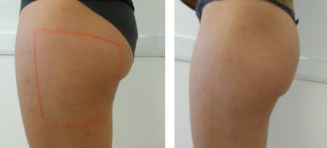 Photo traitement liposonix avant / après