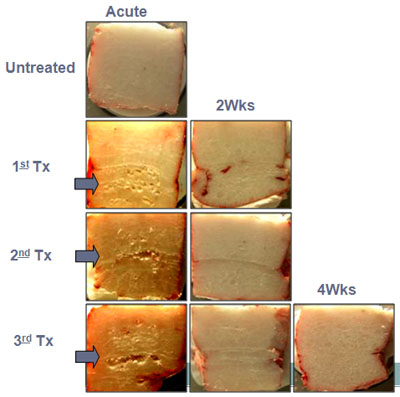 Pulsed Focused Ultrasound (PFU)
