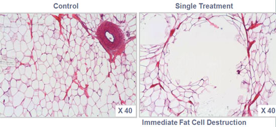 Pulsed Focused Ultrasound (PFU)