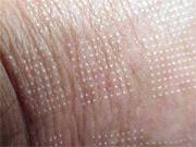 Resurfacing fractionnel CO2