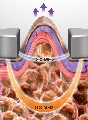 RFVac Vacuum-Assisted RF