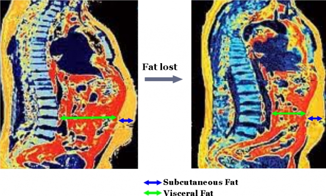 Subcutaneous Fat is Resistant to Diet/Exercise