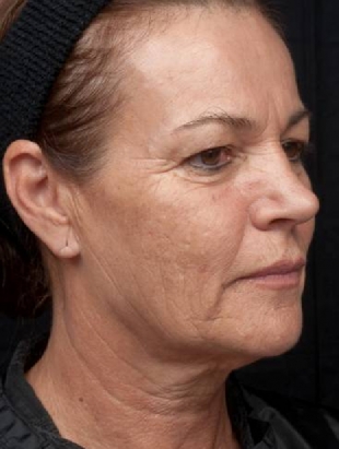 Thermage Face Procedure - 3 Months Post Treatment