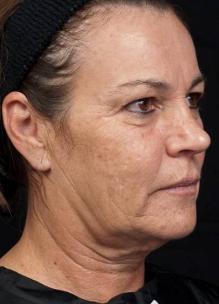 Thermage Face Procedure - Before Thermage