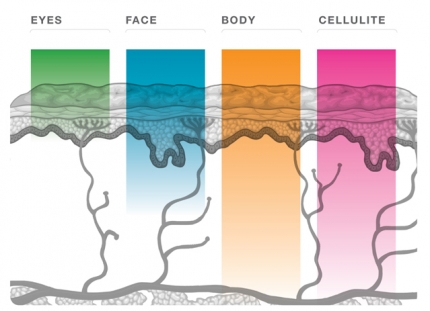 Thermage Tip Heating Profiles