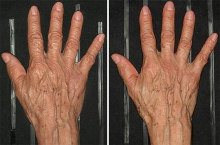 Thermage : Traitement des mains