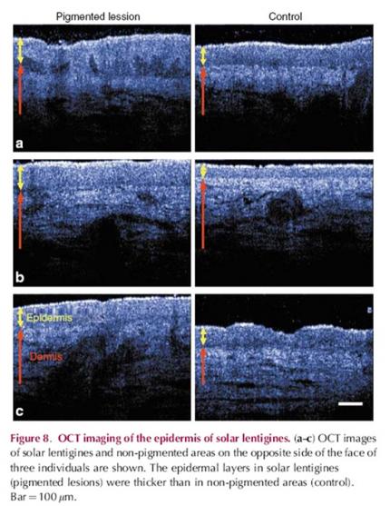 TOMOGRAPHIE PAR COHERENCE OPTIQUE