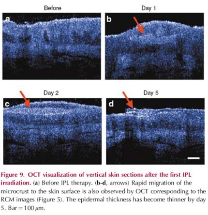 TOMOGRAPHIE PAR COHERENCE OPTIQUE