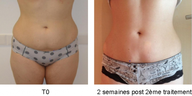 Traitement de l'abdomen Ultrashape