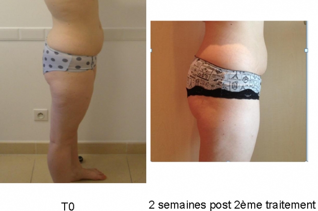 Traitement de l'abdomen Ultrashape