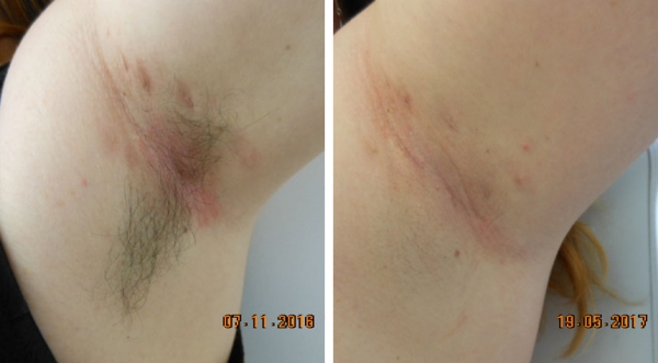 Traitement de la maladie de verneuil par laser ND-Yag