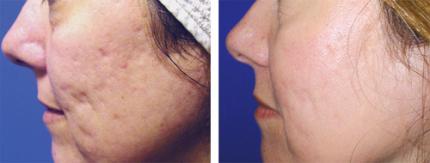 Traitement des cicatrices d'acné au laser Fraxel avant / après 3 séances