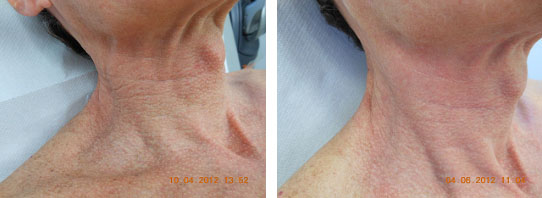 Traitement du cou par laser Fraxel