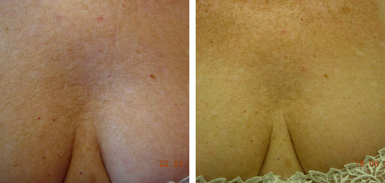 Traitement du décolleté par injections