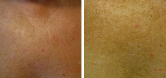 Traitement du décolleté par injections