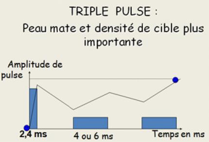 Triple pulse