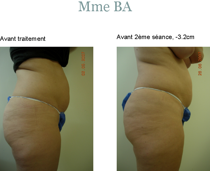 ULTRASHAPE : abdomen