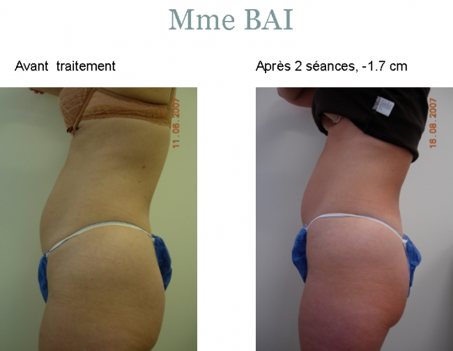 ULTRASHAPE : abdomen