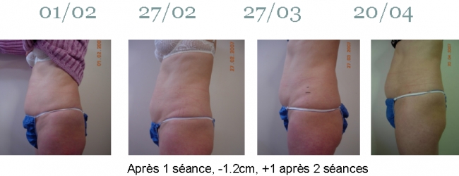 ULTRASHAPE