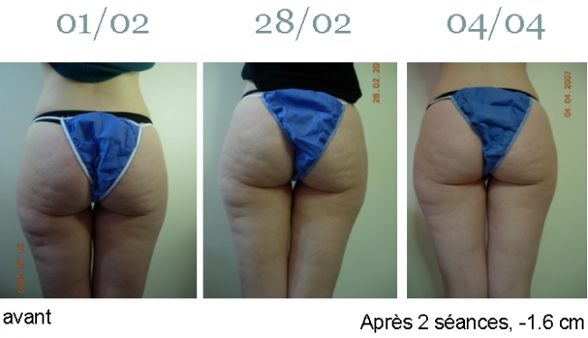 ULTRASHAPE